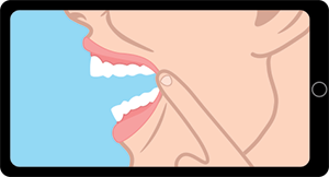 Smile-Assessment-Left